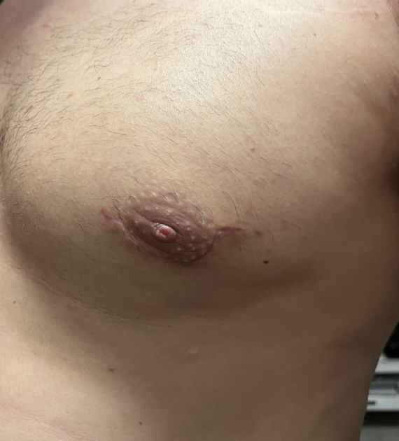 Gynecomastia Consultation Image